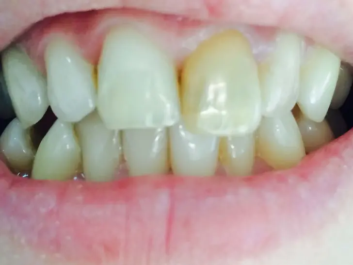 Before: Emax ceramic crowns